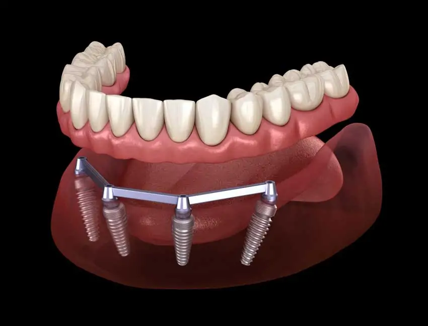 All-on-4 Impianto Dentale