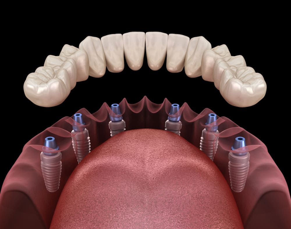 All-on-4 Impianto Dentale