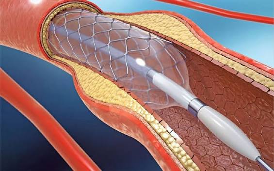 Koroner Stent Ameliyatı