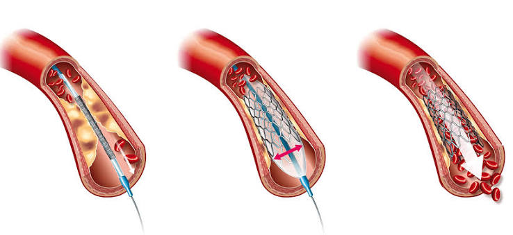 Koroner Stent Ameliyatı