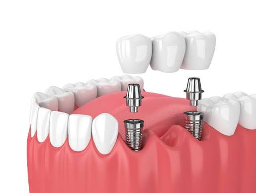 Implant