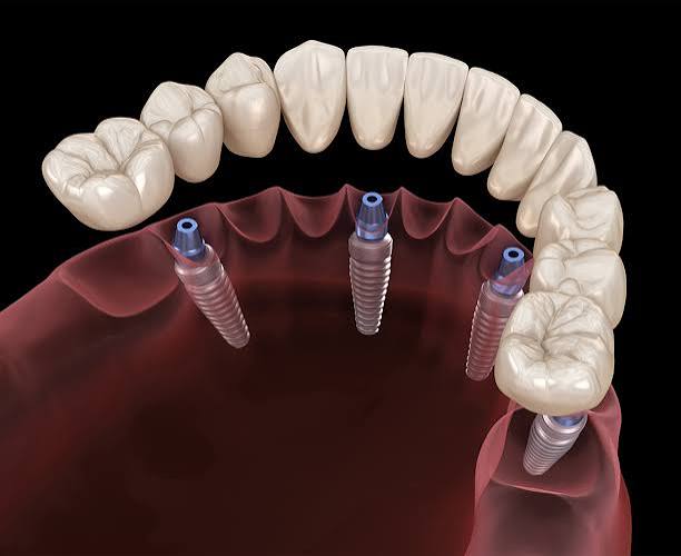 Implant