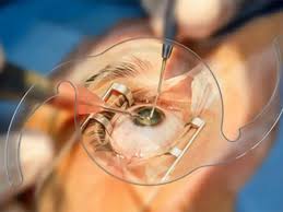 Cataract Surgery