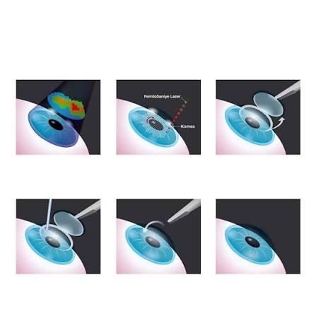 Cataract Surgery