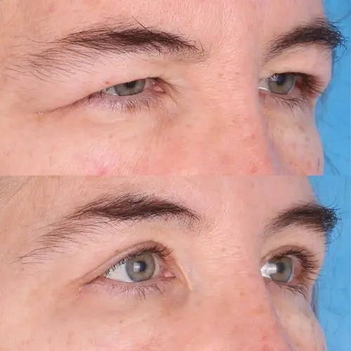 Eyelid Surgery (Blepharoplasty)