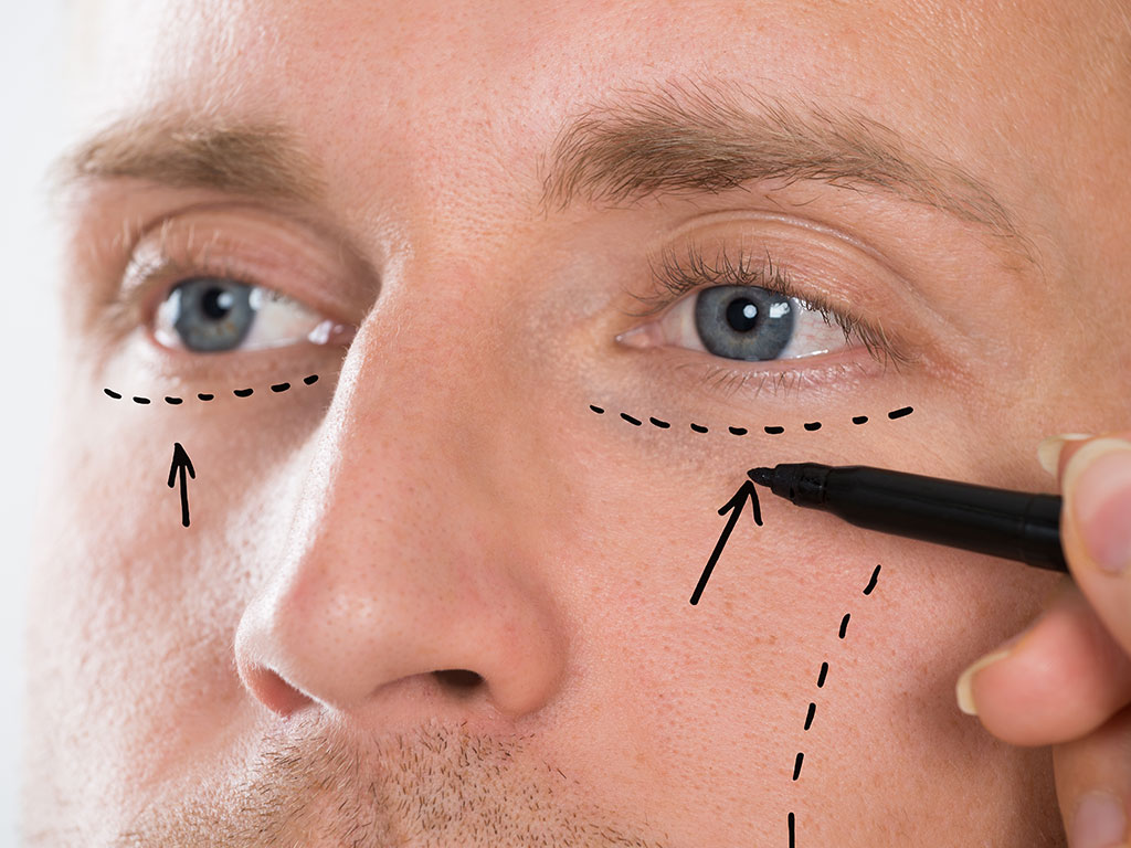 Eyelid Surgery (Blepharoplasty)