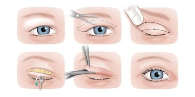 Eyelid Surgery (Blepharoplasty)